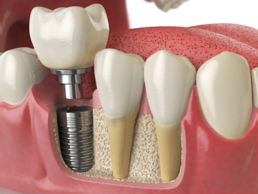 Implantes dentales